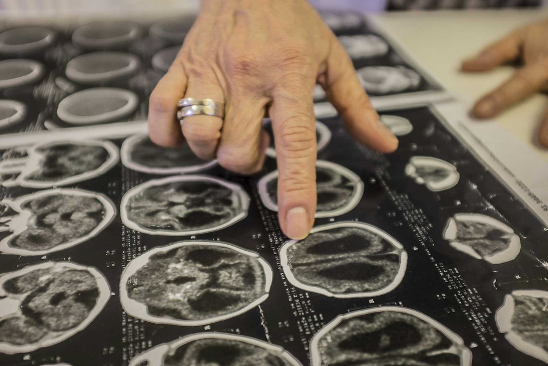 Angela Rocha, 67, infectologist at the Oswaldo Cruz hospital in Recife, Pernambuco, showing a brain tomography of an infant with microcephaly