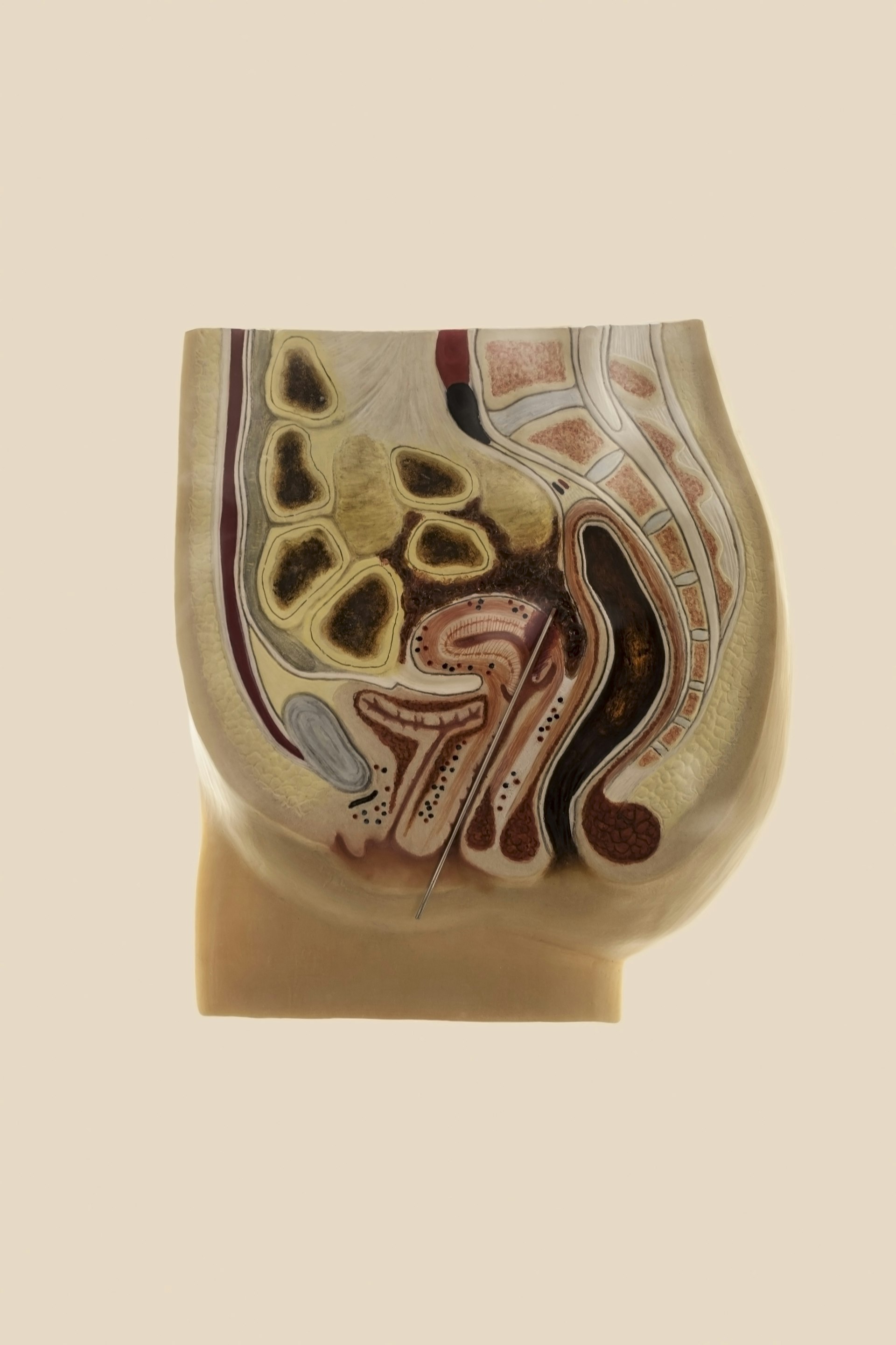 3D cross-section illustrating a knitting-needle abortion.
